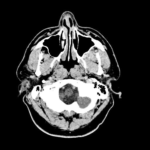 Buccal fat pad arteriovenous malformation (Radiopaedia 70936-81142 Axial non-contrast 36).jpg
