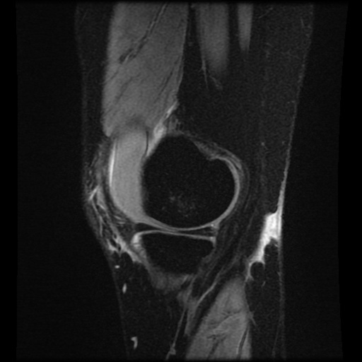 File:Bucket handle meniscus tear (Radiopaedia 56916-63751 H 69).jpg
