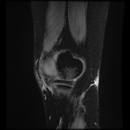 Bucket handle meniscus tear (Radiopaedia 56916-63751 H 75).jpg