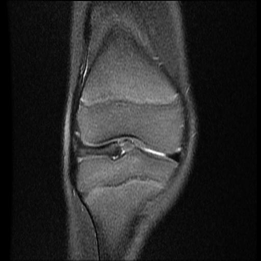 File:Bucket handle tear - lateral meniscus (Radiopaedia 72124-82634 Coronal PD fat sat 6).jpg
