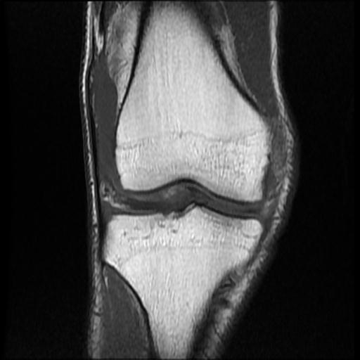 File:Bucket handle tear - medial meniscus (Radiopaedia 69245-79026 Coronal T1 8).jpg