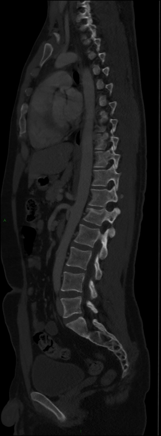 Burst fracture (Radiopaedia 83168-97542 Sagittal bone window 72).jpg