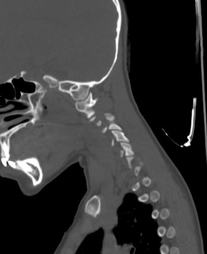 Butterfly vertebra (Radiopaedia 77903-90209 Sagittal bone window 2).jpg