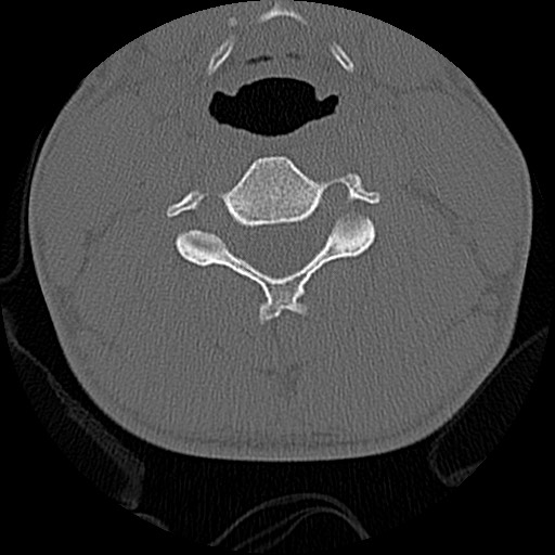 File:C5 facet fracture (Radiopaedia 58374-65499 Axial bone window 46).jpg