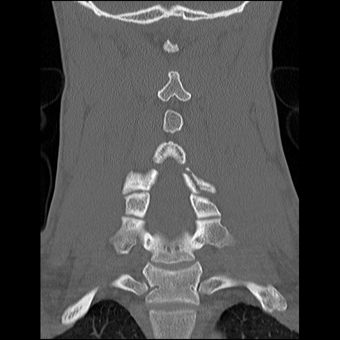 C5 facet fracture (Radiopaedia 58374-65499 Coronal bone window 37).jpg