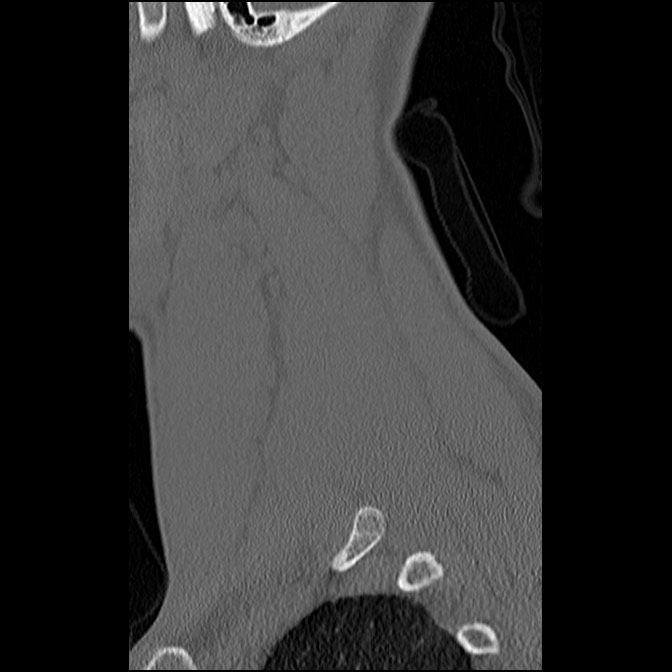 C5 facet fracture (Radiopaedia 58374-65499 Sagittal bone window 15).jpg