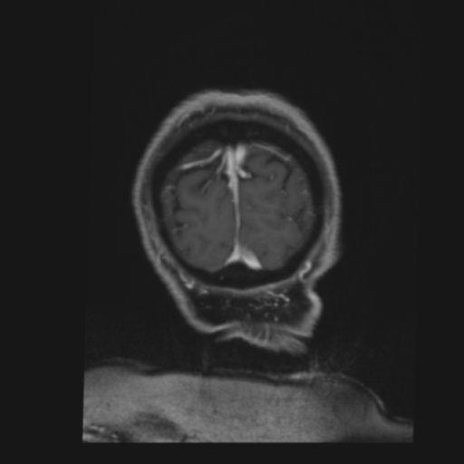 CNS lymphoma with steroid response (Radiopaedia 37980-39921 Coronal T1 C+ 49).png