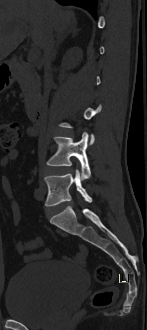 Calcaneal fractures with associated L2 burst fracture (Radiopaedia 71671-82493 Sagittal bone window 53).jpg