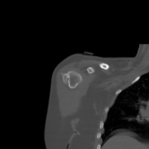 File:Calcific tendinitis of the infraspinatus tendon (Radiopaedia 87256-103539 Coronal bone window 17).jpg