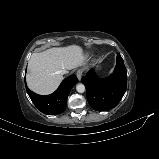 Calcified adrenal glands and Spigelian hernia (Radiopaedia 49741-54988 A 28).jpg