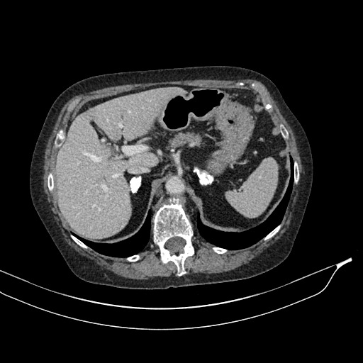 Calcified adrenal glands and Spigelian hernia (Radiopaedia 49741-54988 A 51).jpg
