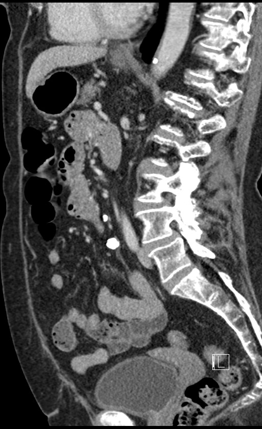 Calcified adrenal glands and Spigelian hernia (Radiopaedia 49741-54988 C 74).jpg