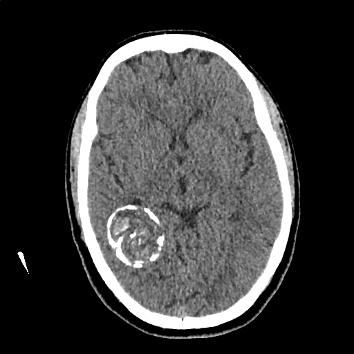Calcified cerebral hydatid cyst (Radiopaedia 65603-74717 Axial non-contrast 32).jpg