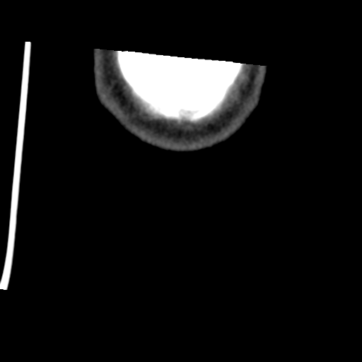 Calcifying pseudoneoplasm of neuraxis (Radiopaedia 44076-47617 Coronal non-contrast 54).png