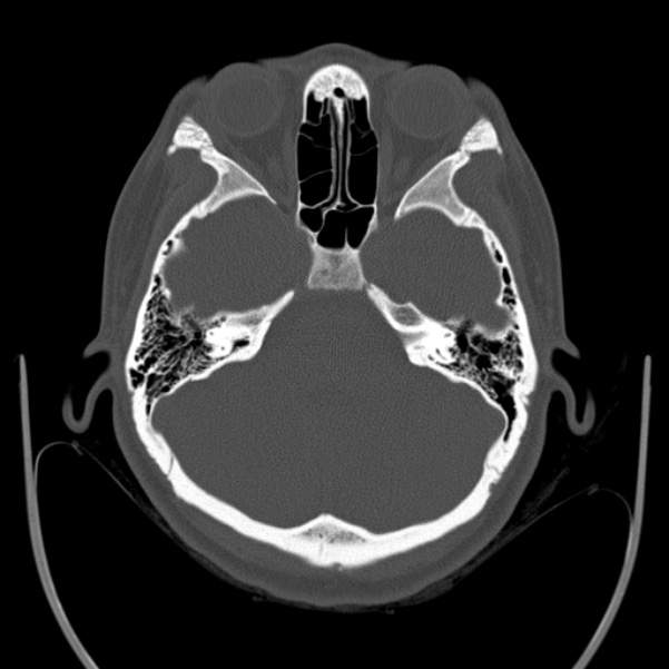Calvarial osteoma (Radiopaedia 36520-38079 Axial bone window 30).jpg