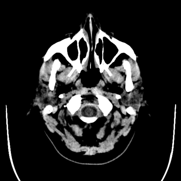 Calvarial osteoma (Radiopaedia 36520-38079 Axial non-contrast 3).jpg