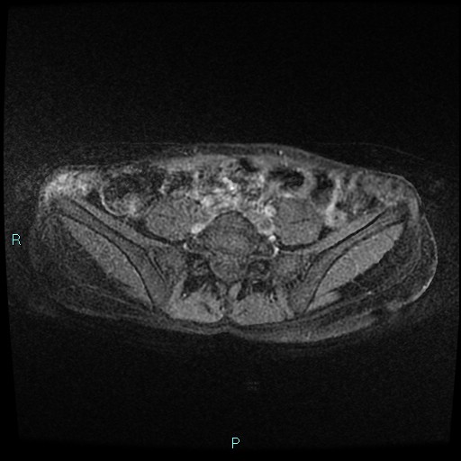 File:Canal of Nuck cyst (Radiopaedia 55074-61448 Axial T1 C+ fat sat 1).jpg