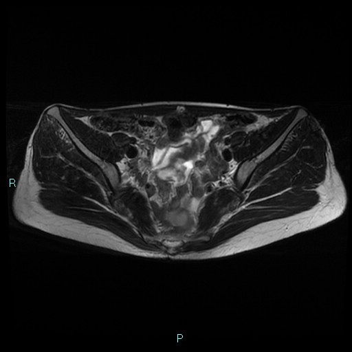 File:Canal of Nuck cyst (Radiopaedia 55074-61448 Axial T2 5).jpg