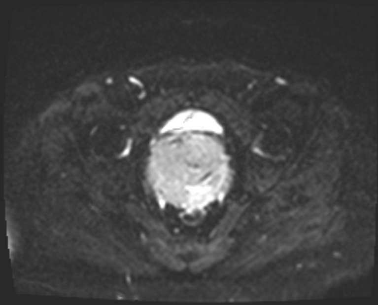 Cancer cervix - stage IIb (Radiopaedia 75411-86615 Axial DWI 13).jpg