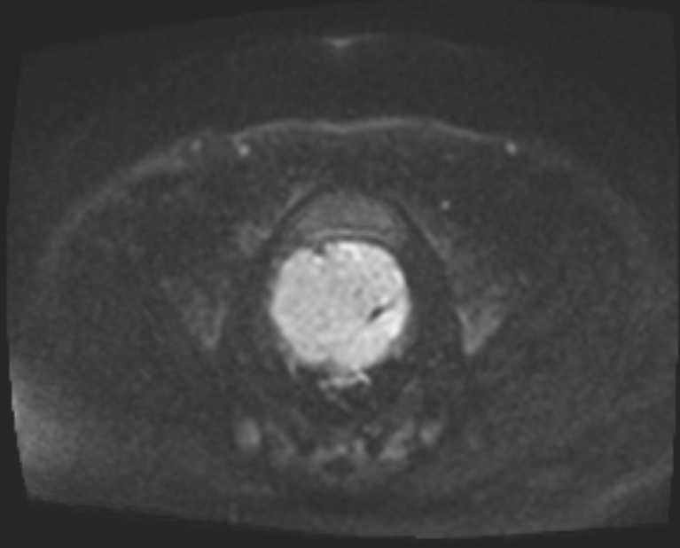 Cancer cervix - stage IIb (Radiopaedia 75411-86615 Axial DWI 72).jpg