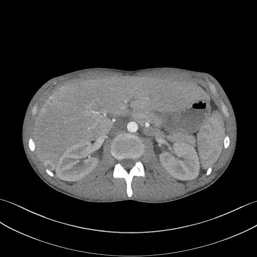 File:Cannonball metastases - testicular choriocarcinoma (Radiopaedia 84510-99891 B 117).jpg