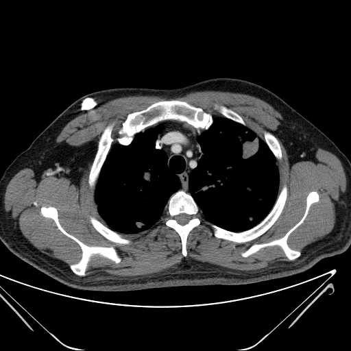 File:Cannonball pulmonary metastases (Radiopaedia 67684-77101 D 62).jpg