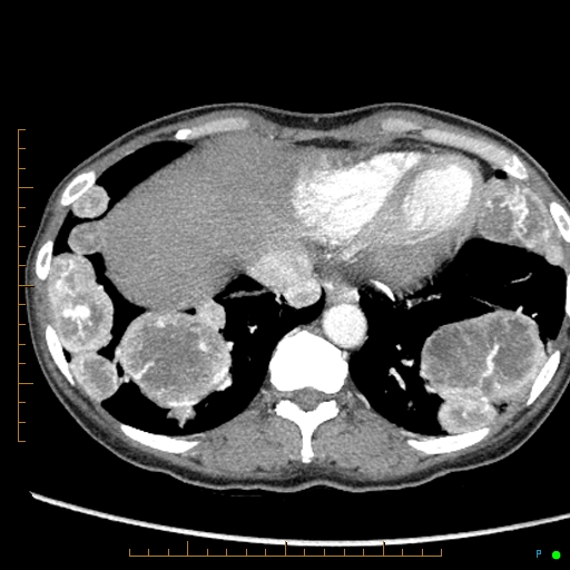 Canonball lung metastasis (Radiopaedia 77634-89837 B 81).jpg