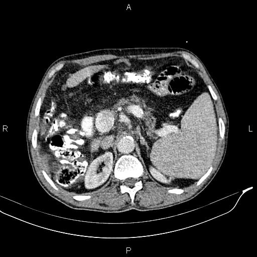 Caput medusae sign - portal hypertension (Radiopaedia 64007-72759 A 25).jpg