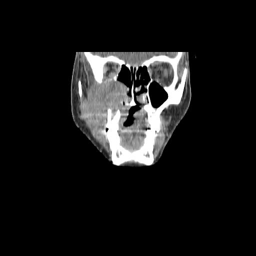 Carcinoma of the maxillary antrum (Radiopaedia 53805-59888 Coronal C+ delayed 37).jpg