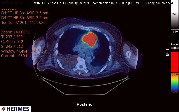 File:Cardiac lymphoma (Radiopaedia 38690-40871 Integrated PET-CT 9).jpg