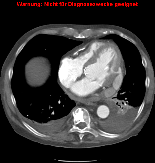 File:Cardiac perforation following transcatheter aortic valve implantation (Radiopaedia 23714-23863 A 9).png