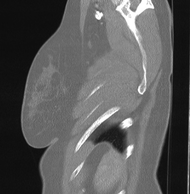 Cardiac sarcoidosis (Radiopaedia 74548-85534 Sagittal lung window 4).jpg