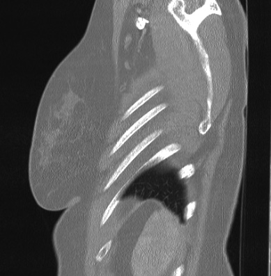 Cardiac sarcoidosis (Radiopaedia 74548-85534 Sagittal lung window 5).jpg