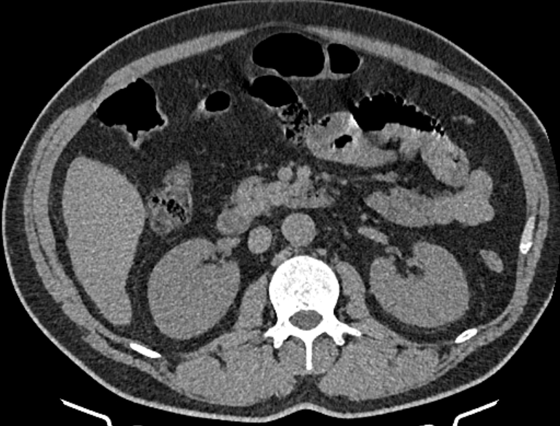 Cardiogenic pulmonary edema (Radiopaedia 68180-77678 Axial non-contrast 79).jpg