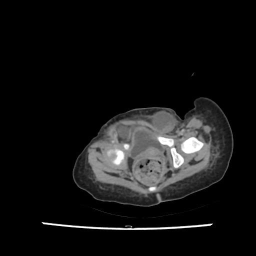 File:Caroli disease with autosomal recessive polycystic kidney disease (ARPKD) (Radiopaedia 89651-106703 B 217).jpg