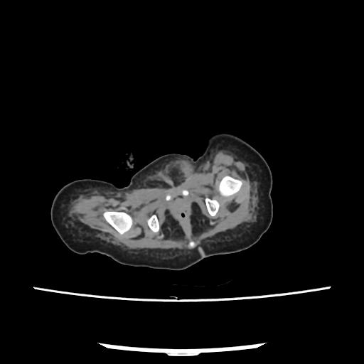 File:Caroli disease with autosomal recessive polycystic kidney disease (ARPKD) (Radiopaedia 89651-106703 E 240).jpg