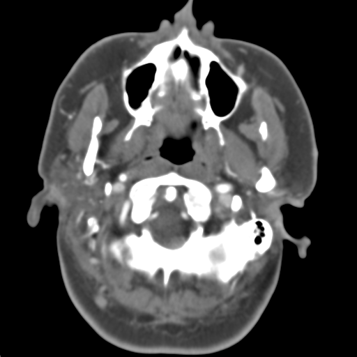 Carotico ophthalmic aneurysm (Radiopaedia 42916-46148 A 49).png