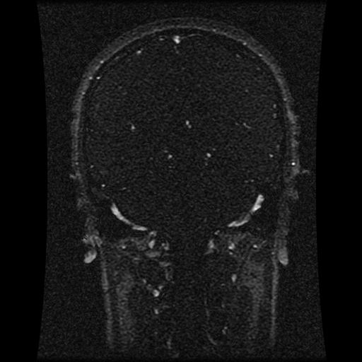 Carotid arterial dissection with acute cerebral infarction (Radiopaedia 26636-26784 MRV 82).jpg