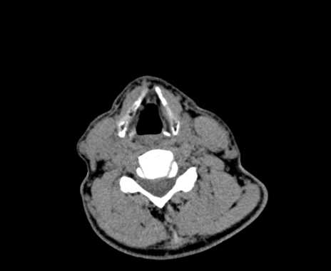 Carotid body tumor (Radiopaedia 61750-69757 Axial non-contrast 70).jpg