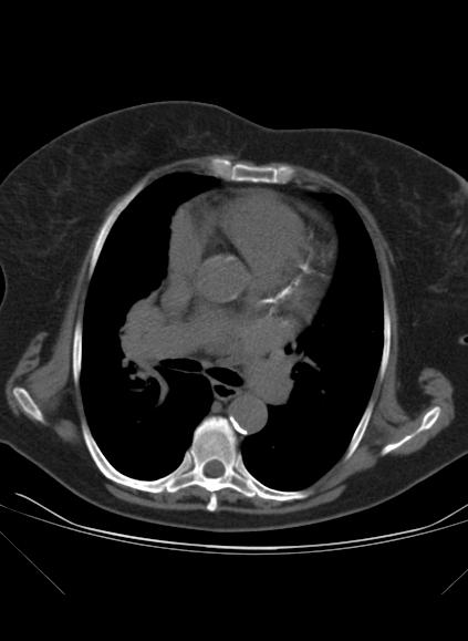 File:Caseous mitral annular calcification (Radiopaedia 61219-69122 Axial non-contrast 1).jpg