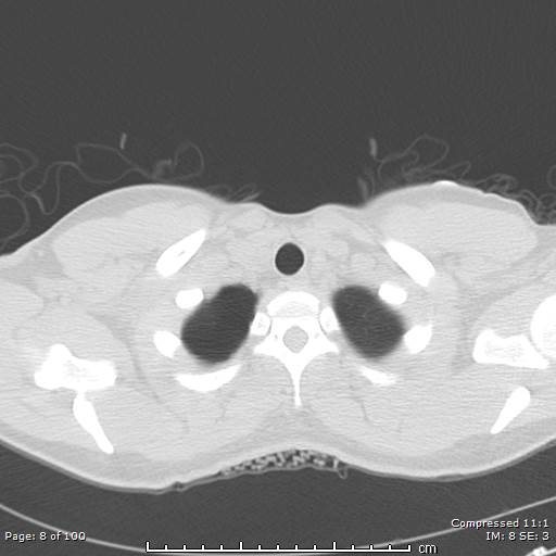Catamenial pneumothorax (Radiopaedia 54382-60600 Axial non-contrast 8).jpg