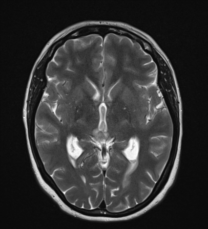 File:Cavernoma with bleed - midbrain (Radiopaedia 54546-60774 Axial T2 13).png