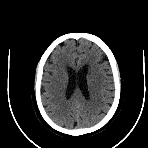 Cavernous hemangioma of the cerebellar falx (Radiopaedia 73025-83723 Axial non-contrast 90).jpg