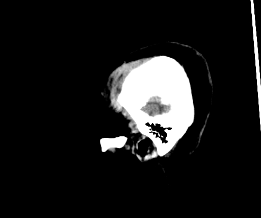Cavernous hemangioma of the cerebellar falx (Radiopaedia 73025-83723 B 27).jpg