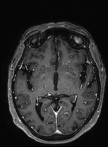 Cavernous hemangioma of the cerebellar falx (Radiopaedia 73025-83724 Axial T1 C+ 180).jpg