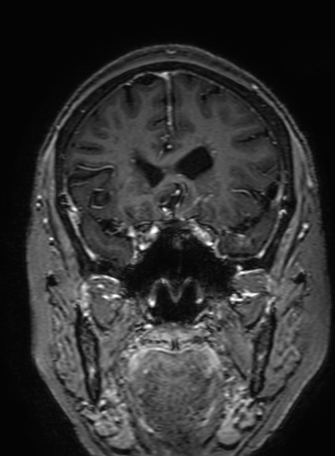 Cavernous hemangioma of the cerebellar falx (Radiopaedia 73025-83724 Coronal T1 C+ 126).jpg