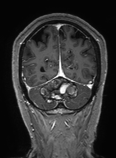 Cavernous hemangioma of the cerebellar falx (Radiopaedia 73025-83724 Coronal T1 C+ 303).jpg