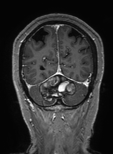 Cavernous hemangioma of the cerebellar falx (Radiopaedia 73025-83724 Coronal T1 C+ 308).jpg