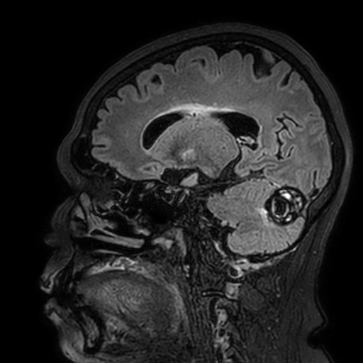 Cavernous hemangioma of the cerebellar falx (Radiopaedia 73025-83724 Sagittal FLAIR 81).jpg