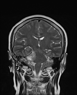 File:Cavernous sinus meningioma (Radiopaedia 63682-72367 Coronal T2 11).jpg